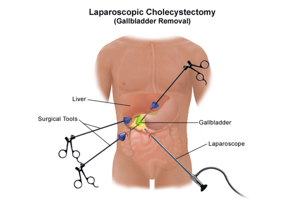 Laparoscopic Cholecystectomy