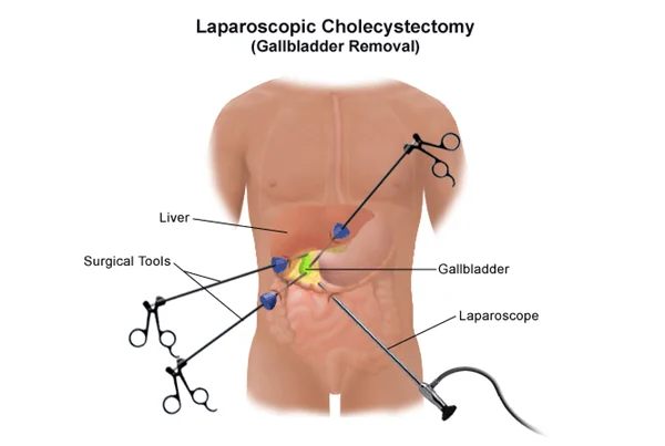 Laparoscopic Cholecystectomy