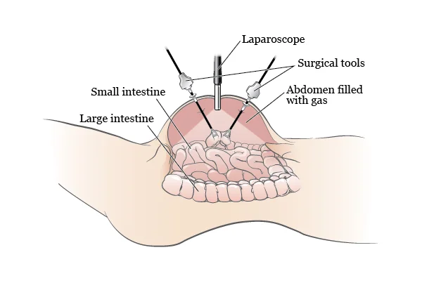 Diagnostic Laparoscopy