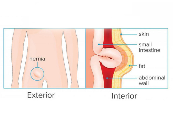 Laparoscopic Inguinal Hernia Repair