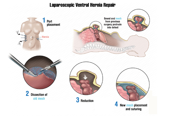 Laparoscopic Ventral Hernia Repair
