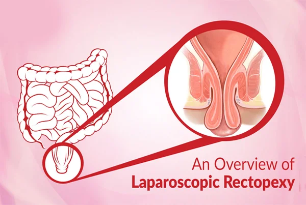Laparoscopic Rectopexy