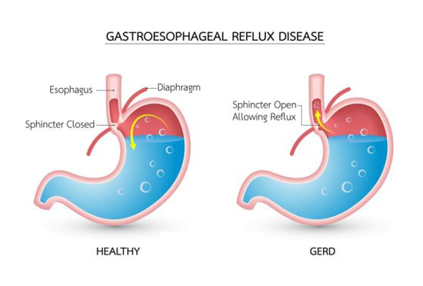 Laparoscopic GERD