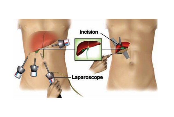 Laparoscopic Liver Hydatid Cyst Removal
