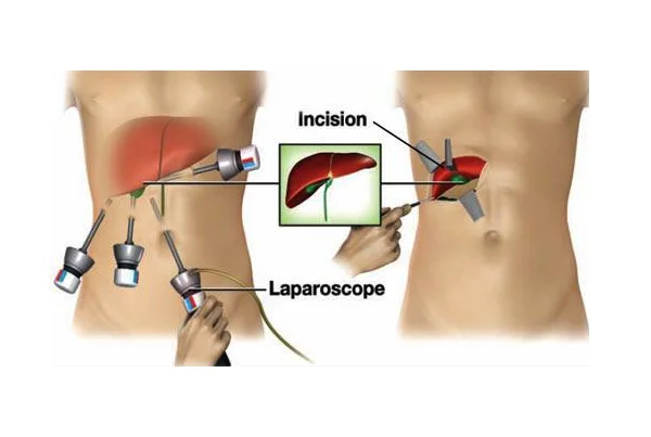 Laparoscopic Surgery
