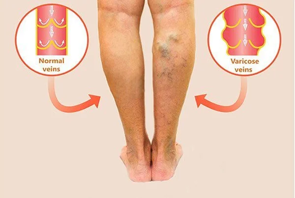 Varicose Veins