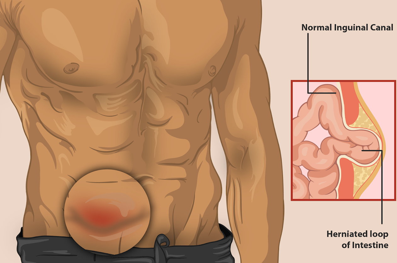 Open Hernia Surgery