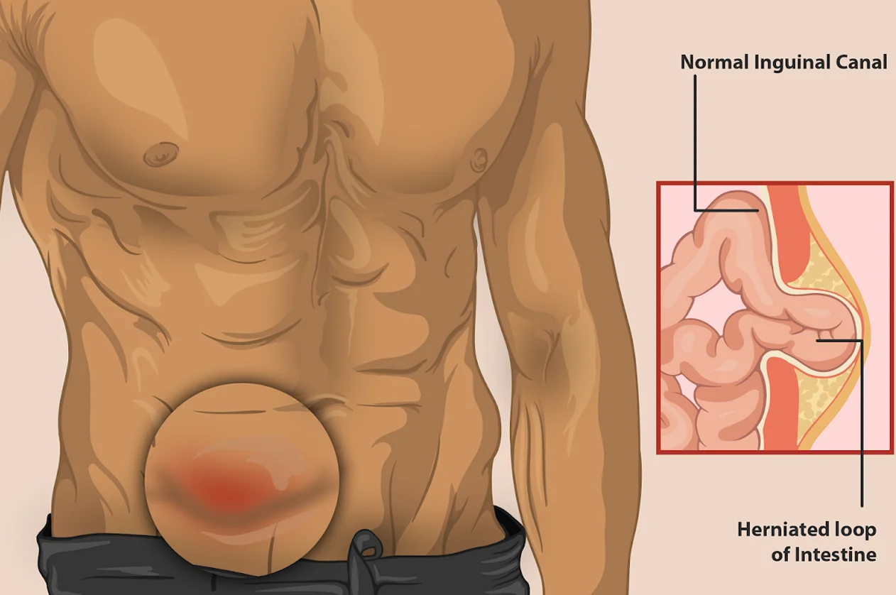 Open Hernia Surgery